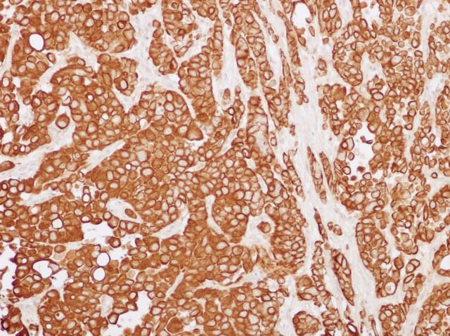 60-0017 61-0017 Ms x CK18 gastric carcinoma 