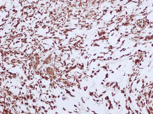 60-0066 61-0066 Ms x Vimentin HIER Synovialsarcoma 