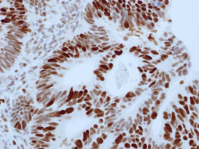 60-0158 61-0158 Ms x MSH6 stained colon ca 