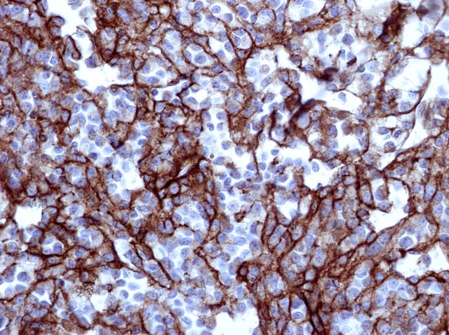 60-0113 61-0113 Rb x Laminin stained Melanoma 