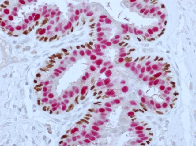 52-0023 Rb x PR and Ms x p63 stained breast tissue X40 double staining kit