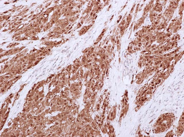 60-0073 Rb x Calretinin x 20 slide1Mesothelioma 05112010002