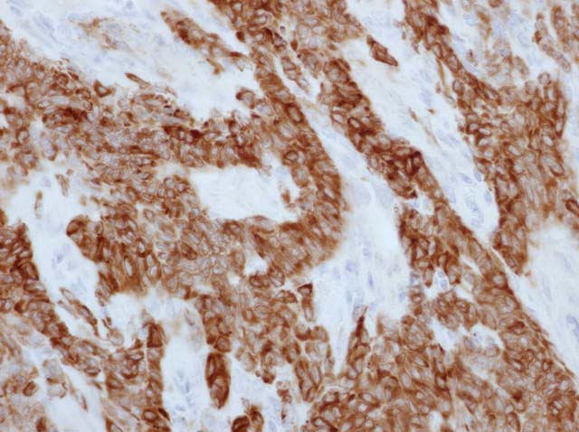 60-0111 61-0111 Ms x Inhibin alpha stained granulosa thecocell tumor of ovary 