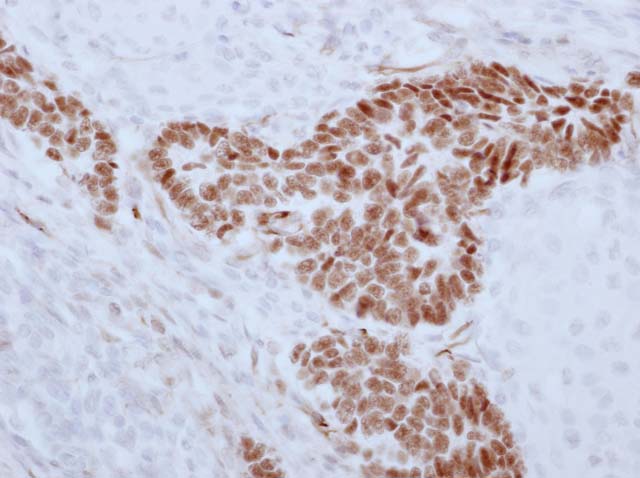 60-0135 61-0135 WT1 Wilms tumor 
