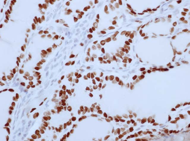 60-0152 61-0152 Ms x TTF1 SPT24 stained Thyroid papillary ca 