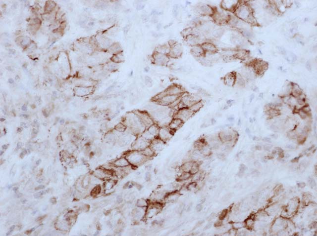 60-0127 61-0127 HBME-1 Mesothelioma 