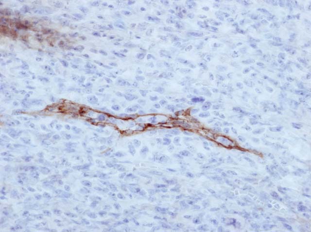 60-0100 61-0100 Ms x D2-40 stained ALCL 