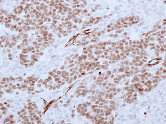 60-0135 61-0135 WT1 Wilms Tumor 