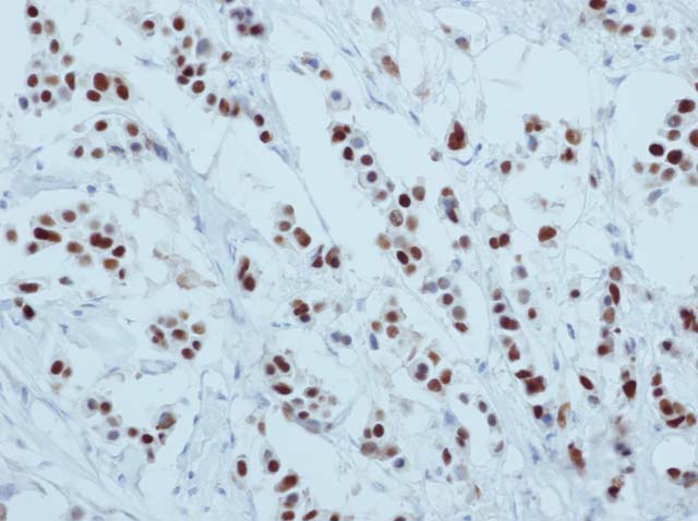 60-0031 61-0031 Ms x ER breast cancer 
